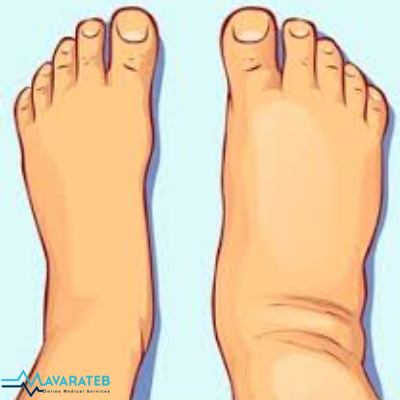 چرا تورم پاها اتفاق می‌افتد؟ از مشکلات وریدی تا کمبود مواد معدنی