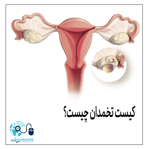 کیست تخمدان چیست؟
