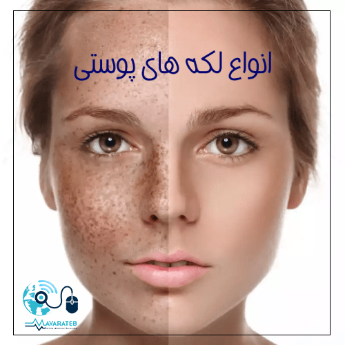 انواع لکه های پوستی
