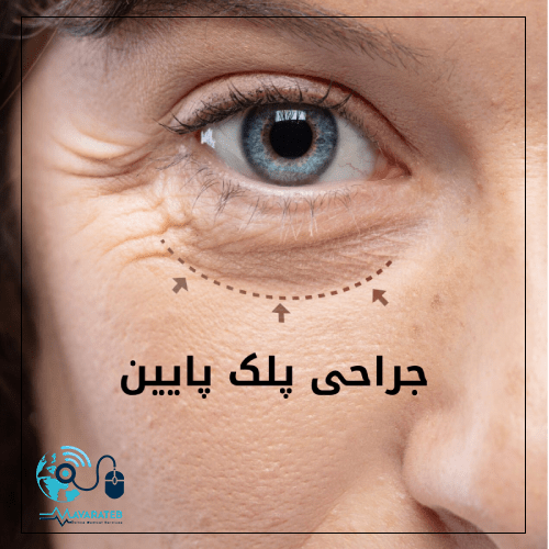 روش های جراحی پلک پایین