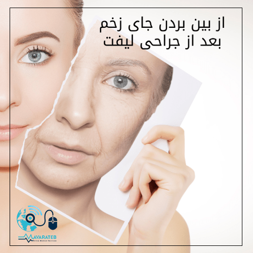 از بین بردن جای زخم لیفت