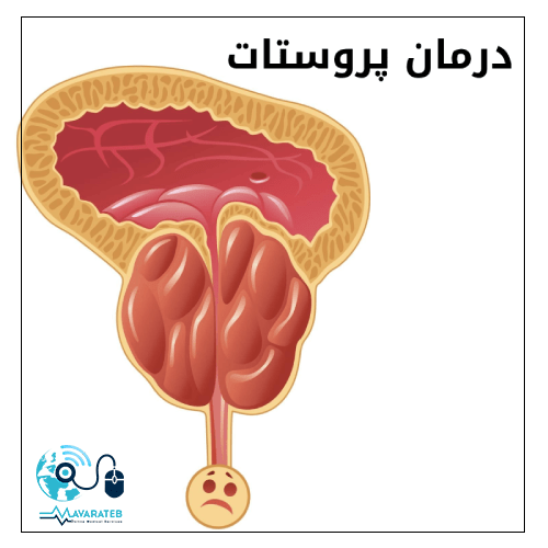 درمان پروستات