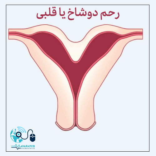 رحم دوشاخ چیست؟