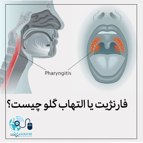 فارنژیت یا التهاب گلو چیست؟