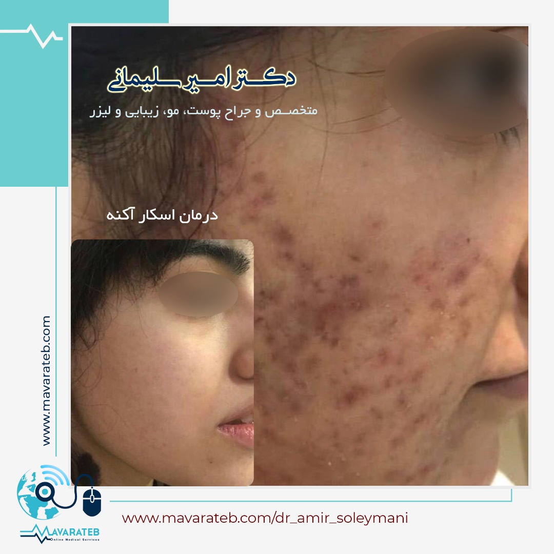 نمونه کار درمان جوش صورت