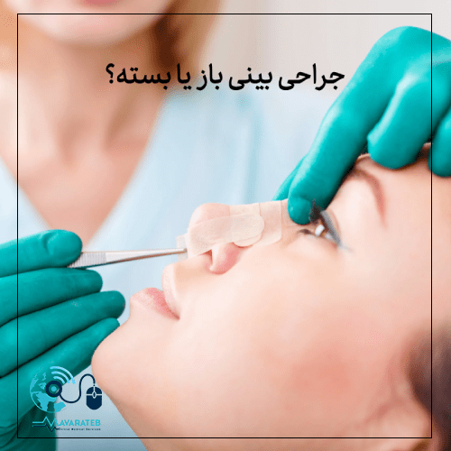 جراحی بینی باز یا بسته؟