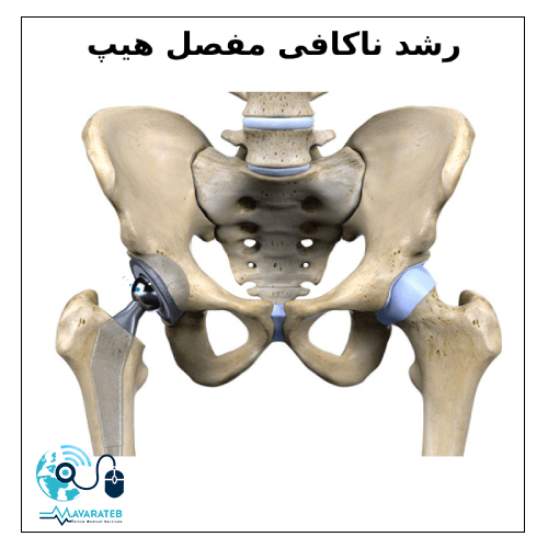 رشد ناکافی مفصل هیپ