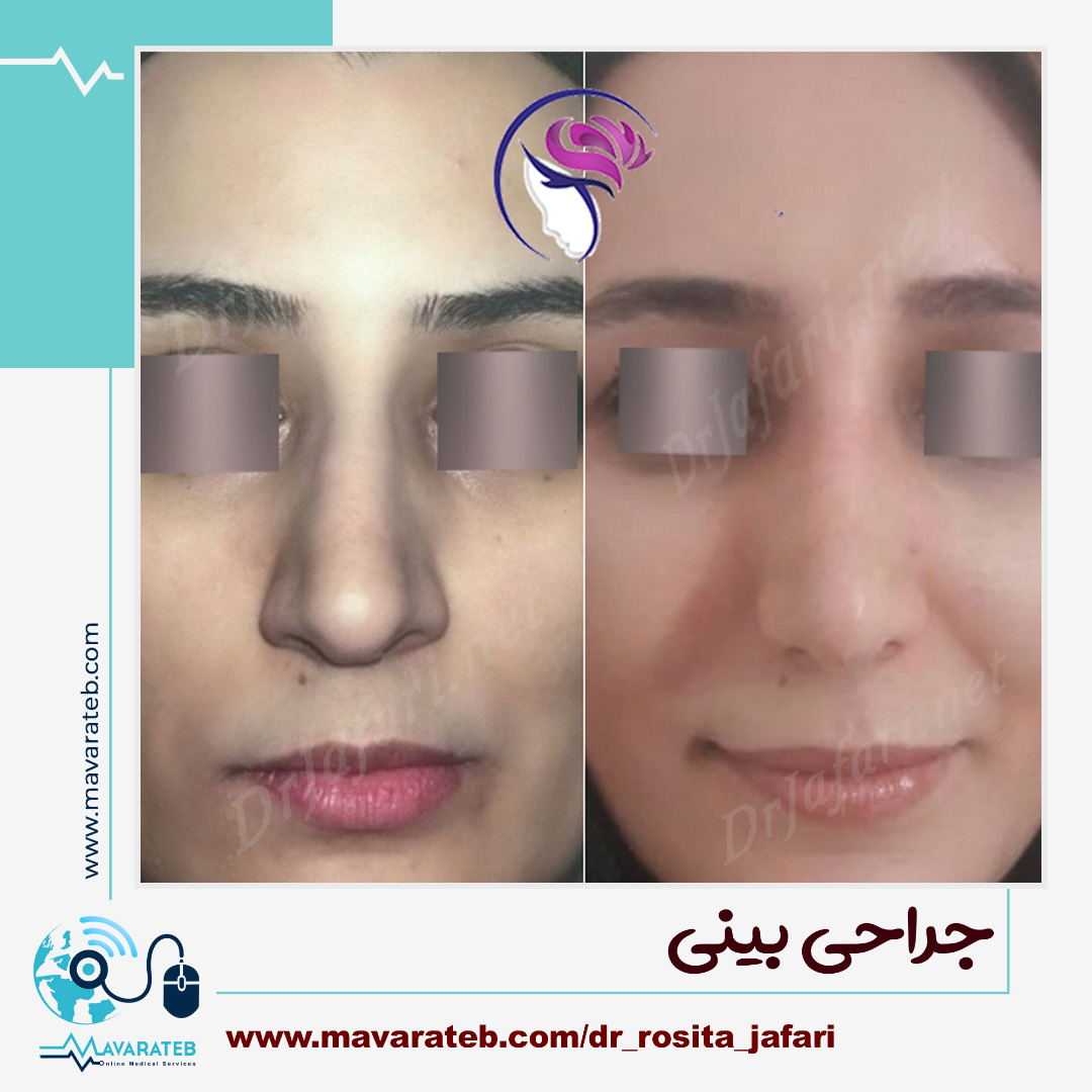 نمونه کار جراحی بینی گوشتی