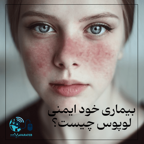 بیماری خود ایمنی لوپوس