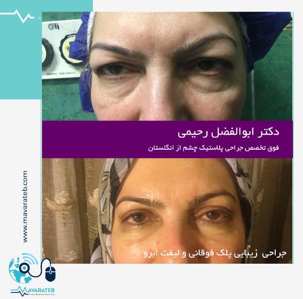 جراحی زیبایی پلک بالا با لیفت ابرو