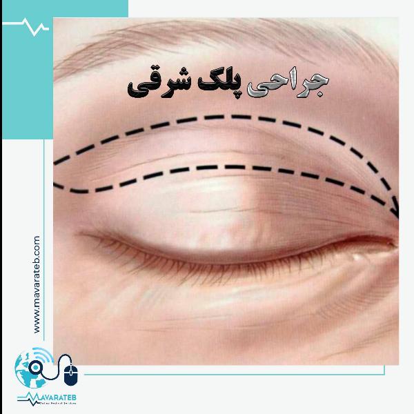 جراحی پلک آسیایی