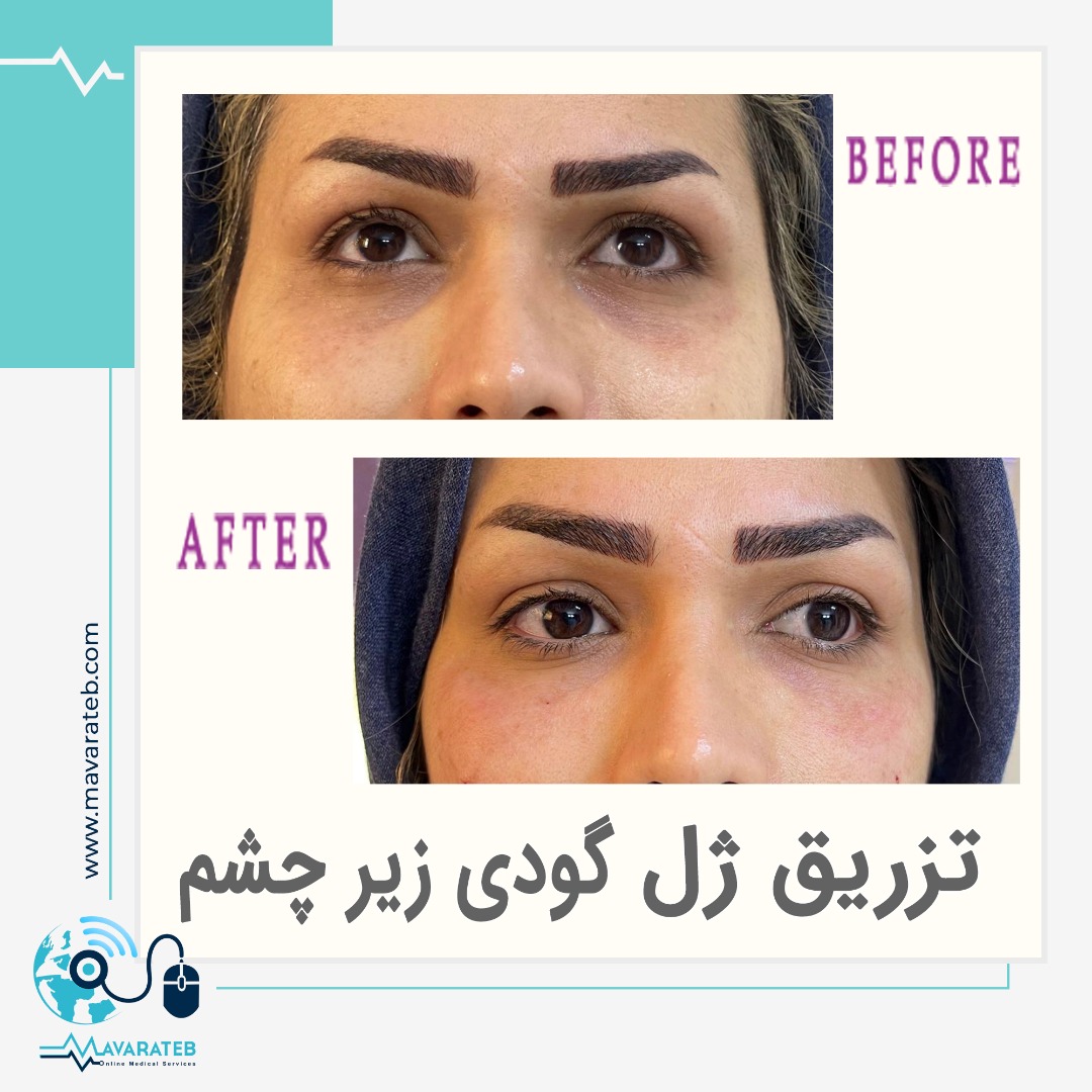 نمونه کار تزریق ژل به زیر چشم