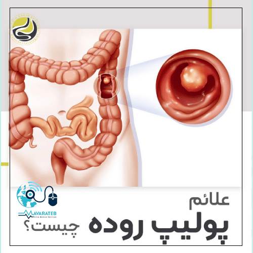 علائم پولیپ روده چیست؟