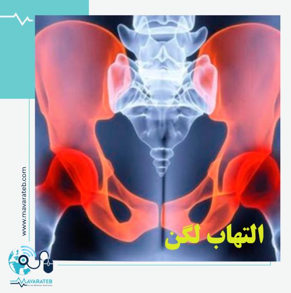التهاب لگن