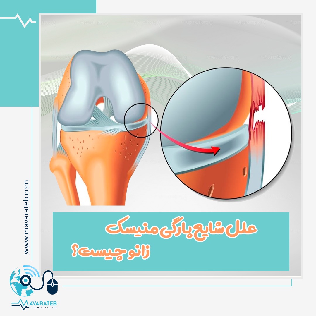 از کجا بفهمیم دچار پارگی منیسک شده ایم؟