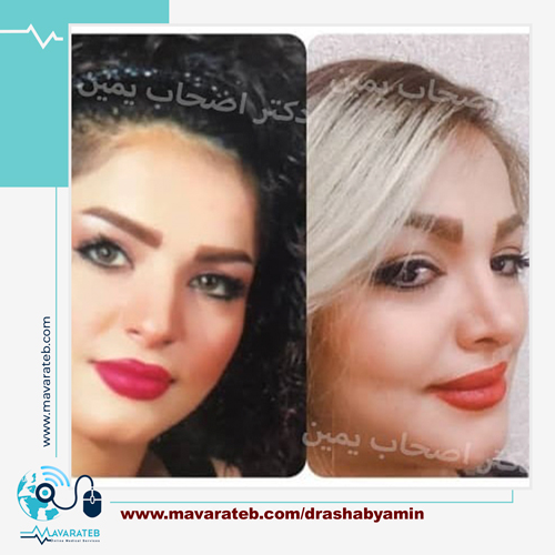چه زمانی برای جراحی بینی ترمیمی مناسب است؟