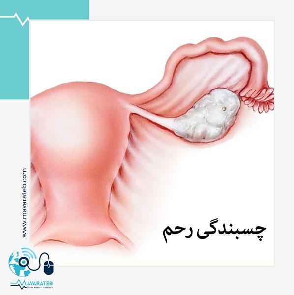 چسبندگی رحم