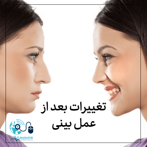 بعد از جراحی بینی بقیه قسمت های صورت تغییر می کند؟