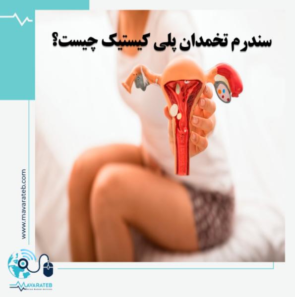 سندرم تخمدان پلی کیستیک