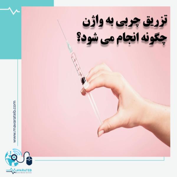 جوانسازی واژن با روش تزریق چربی