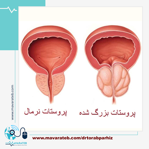 همه چیز درباره پروستات