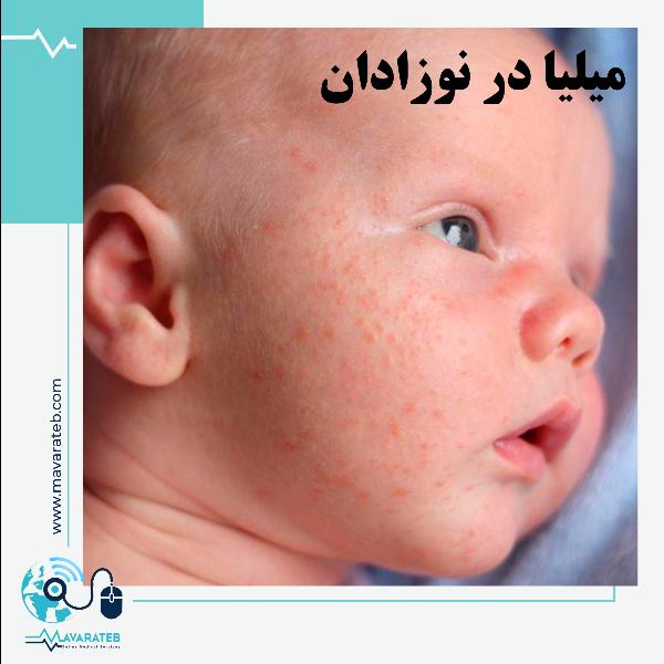 میلیا در نوزادان