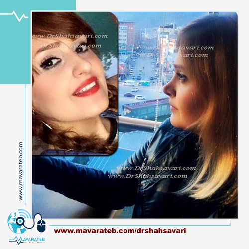 روش عمل بینی استخوانی ؟