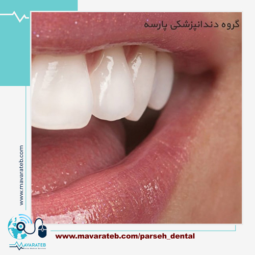 برای سفید کردن دندان چه کنیم؟
