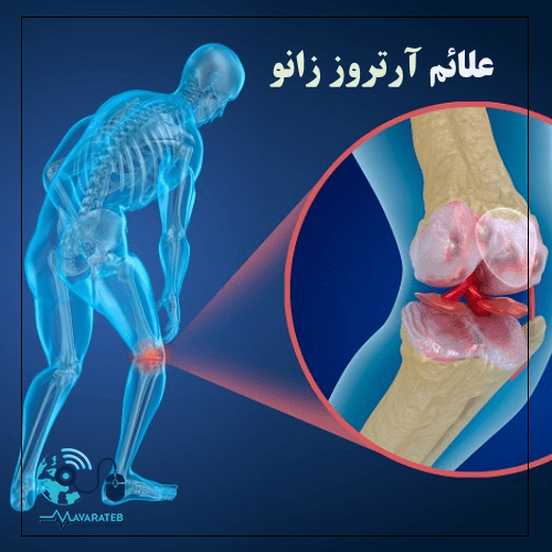 علائم آرتروز زانو