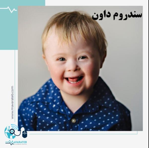 سندروم داون