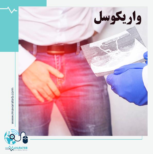 واریکوسل