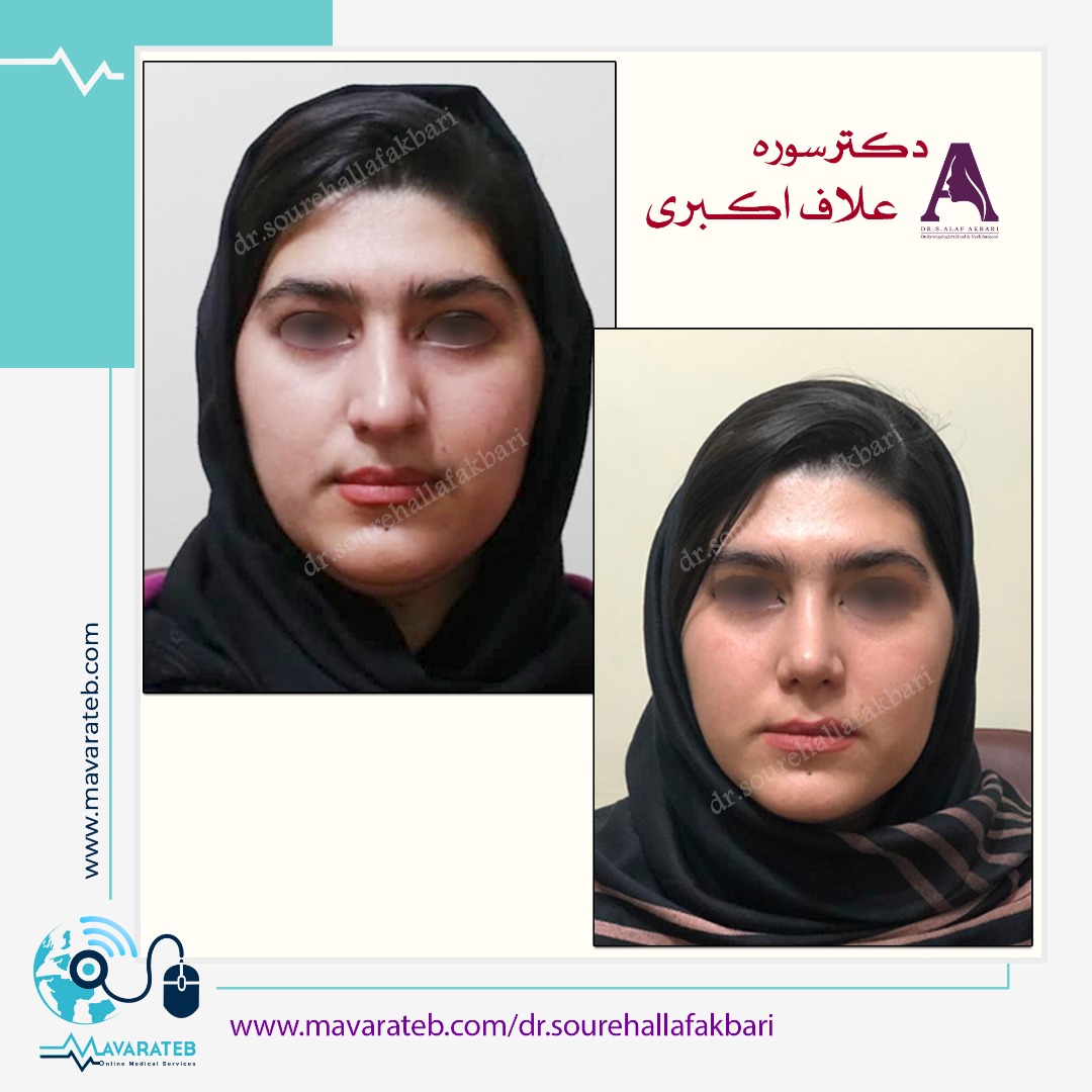 نمونه کار جراحی بینی گوشتی