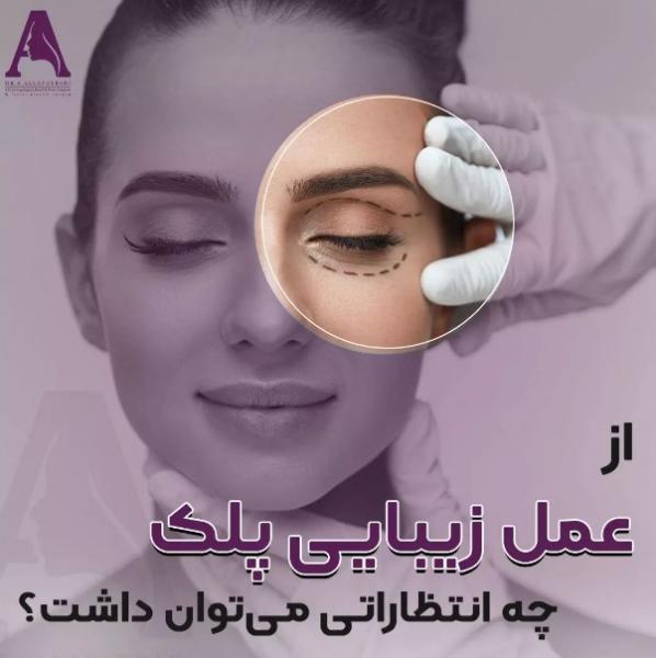نتیجه مادام العمر جراحی زیبایی پلک