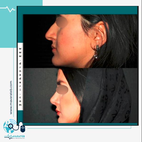 جراحی زیبایی بینی استخوانی