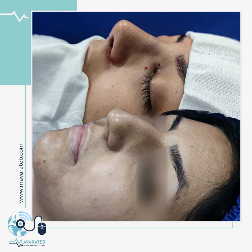 مشاوره آنلاین جراحی بینی در مشهد