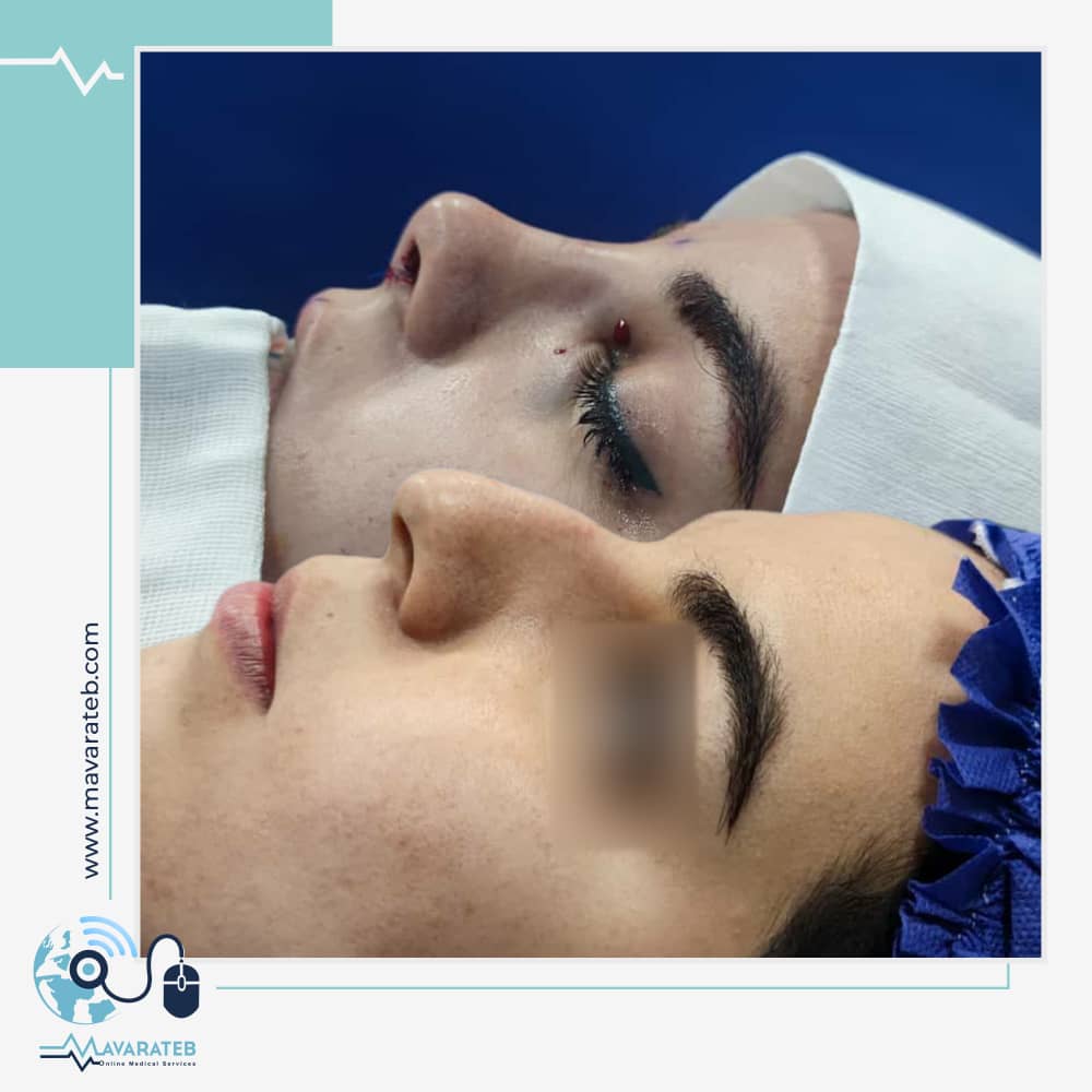 نمونه کار جراحی بینی دکتر رزم آرا