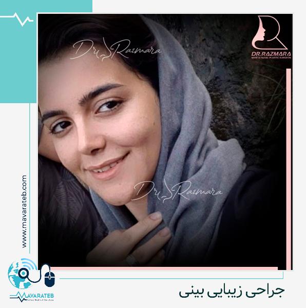 نمونه جراحی بینی ۳ ماه بعد از عمل