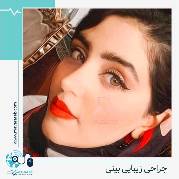 عمل بینی طبیعی 1 ماه بعد از جراحی