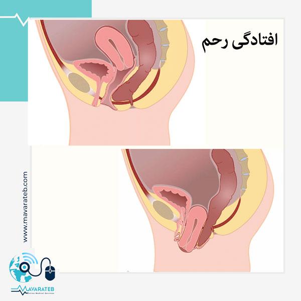 افتادگی رحم