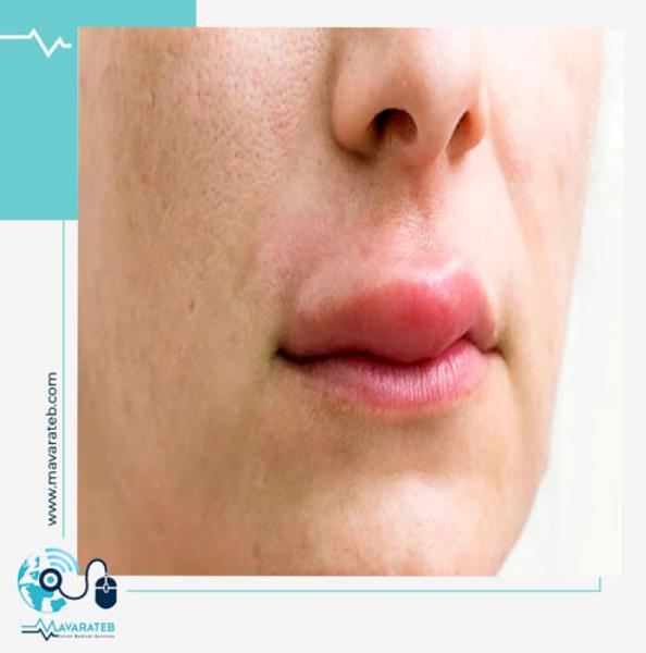 عوارض ژل نامرغوب