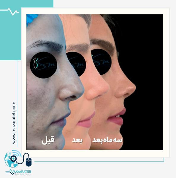 روند تغییر ظاهر بینی بعد از جراحی با مدل طبیعی