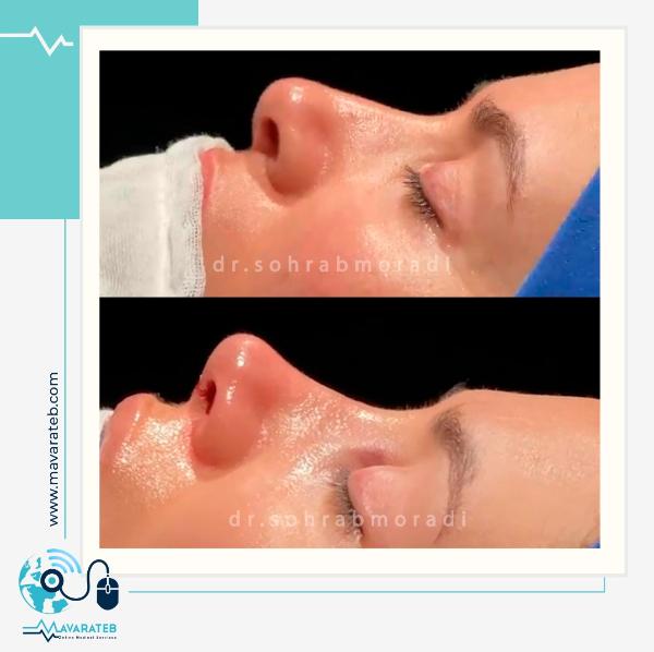 نمونه کار جراحی بینی طبیعی برای خانم جوان
