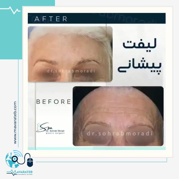 رفع کامل چین و چروک های پیشانی با انجام عمل لیفت اندوسکوپیک