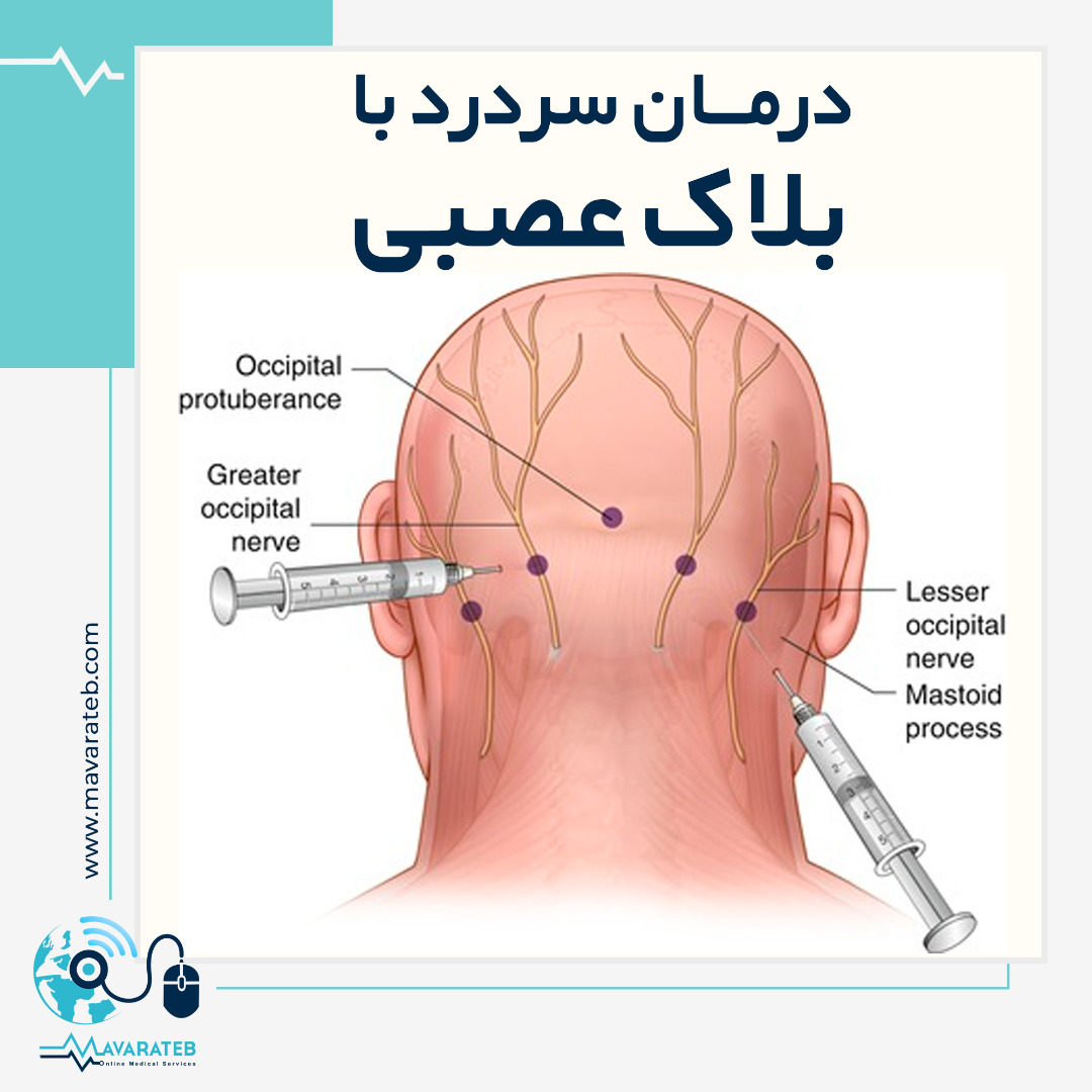 درمان سردرد با بلوک عصبی