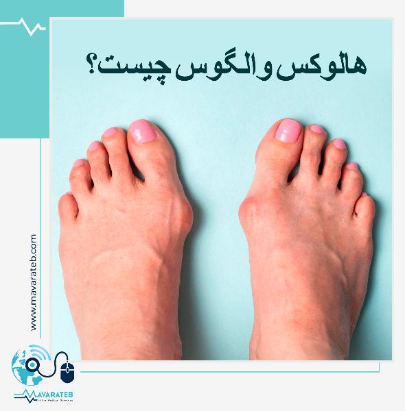 هالوکس والگوس چیست؟