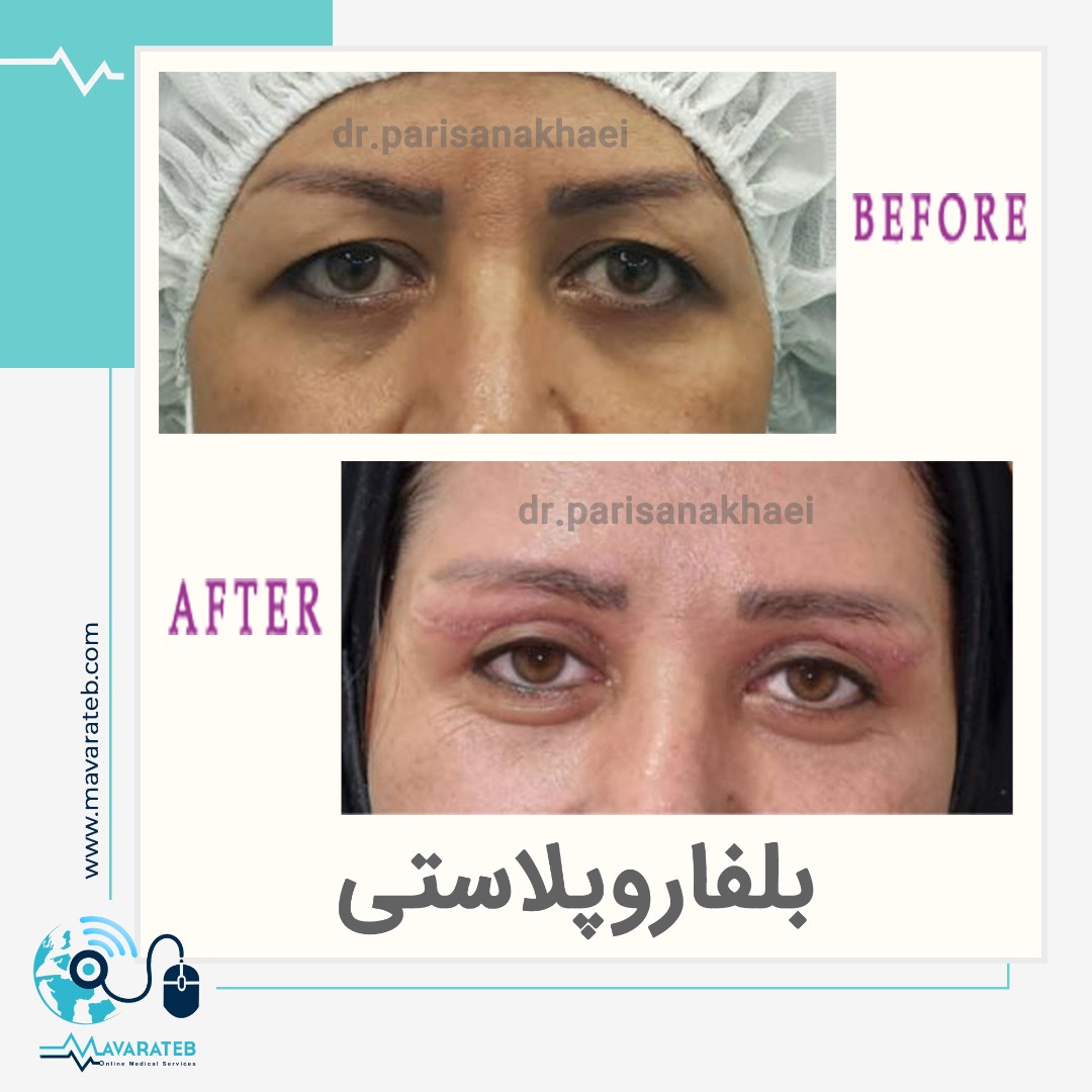 نمونه کار جراحی بلفاروپلاستی