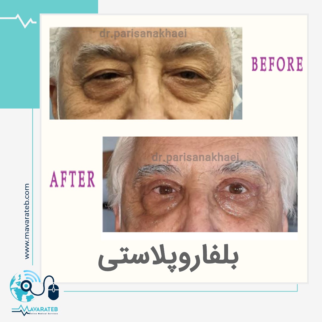 نمونه کار بلفاروپلاستی مردانه