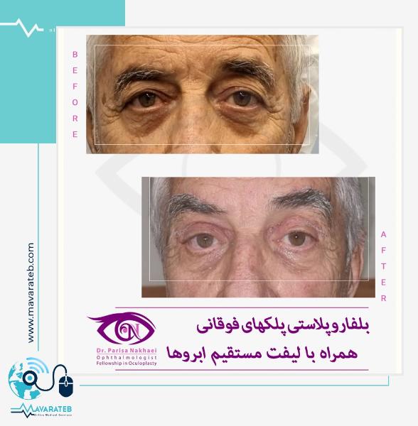 جراحی بلفاروپلاستی پلک فوقانی