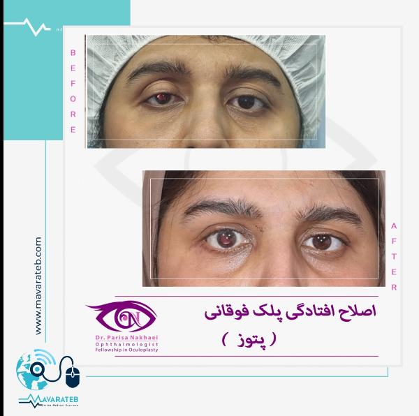 پتوز؛ اصلاح افتادگی پلک بالا