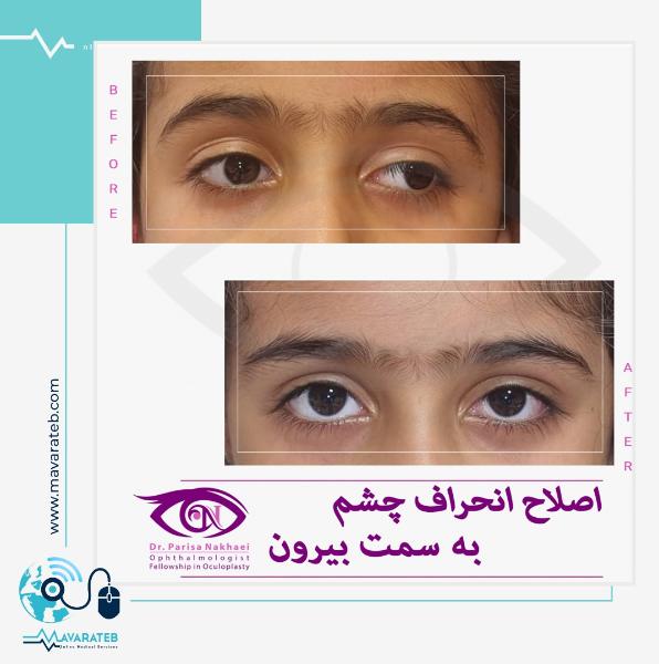 درمان انحراف چشم